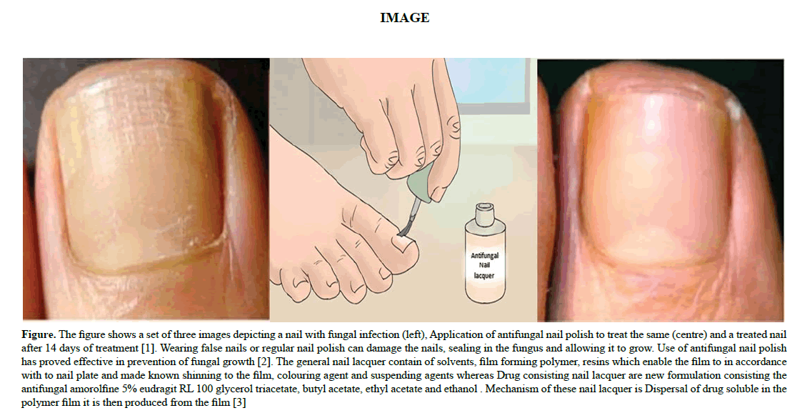 Difungoff antifungal nail polish - ICB Pharma