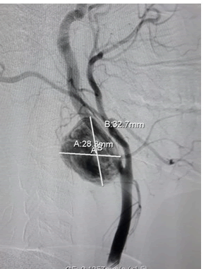 endovascular-therapy