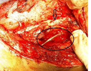 endovascular-therapy