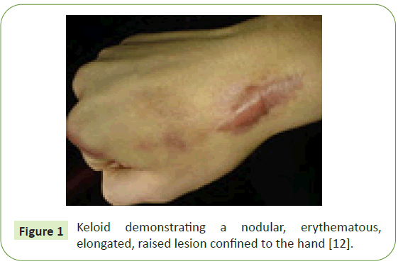 Keloid