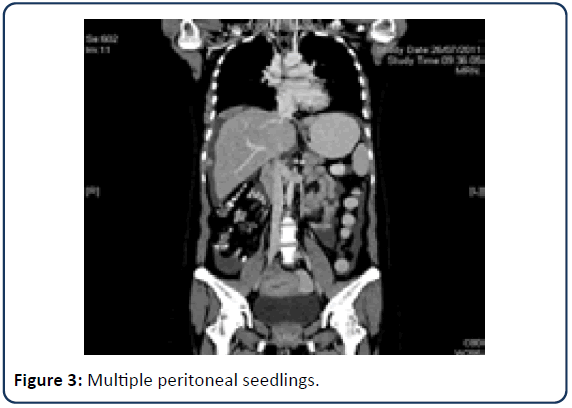 reproductive-medicine-peritoneal