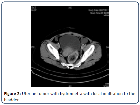 reproductive-medicine-tumor