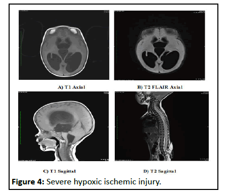 IPCRCR-injury