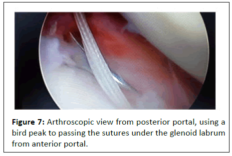 Labrum