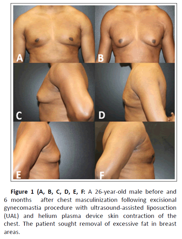Elimination of back roll following ultrasound-assisted liposuction and