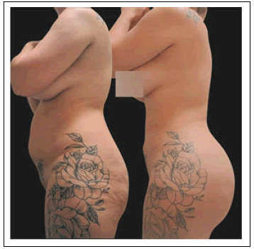 aesthetic-reconstructive-Lipo