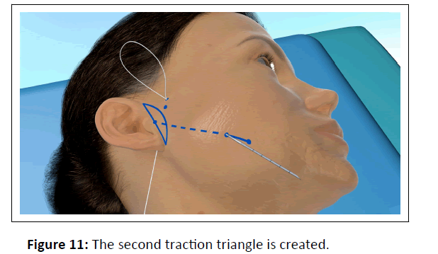 aesthetic-second-traction