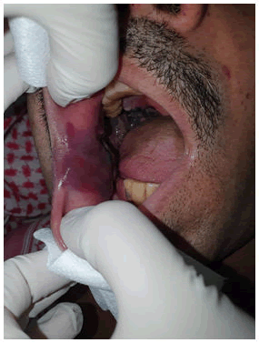 dentistry-craniofacial-hematoma