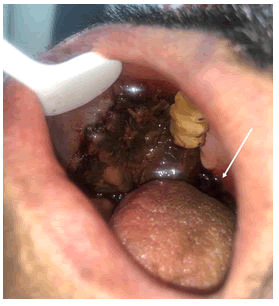 dentistry-craniofacial-hematoma