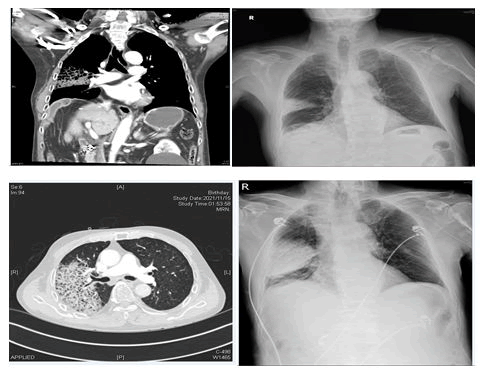 emergency-internal-pneumonia