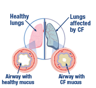 genetics-molecular-cystic