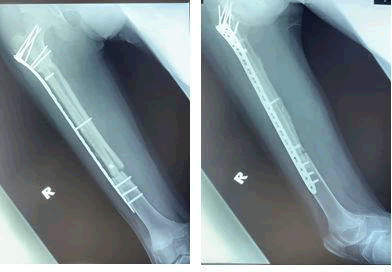 journal-clinical-femur