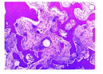 journal-neoplasm-bone