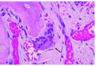 journal-neoplasm-bone