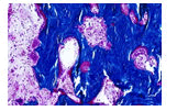 journal-neoplasm-bone