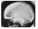 journal-neoplasm-bone