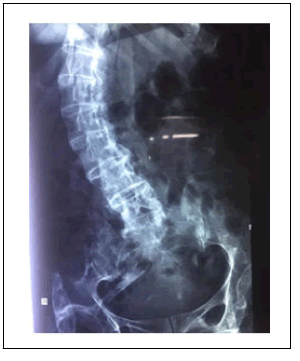 journal-rare-Lumbosacral