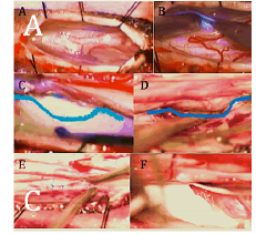 journal-rare-laminectomy