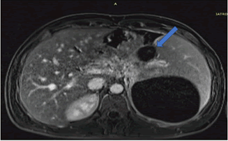 journal-rare-preoperativeT1-axia-l-view