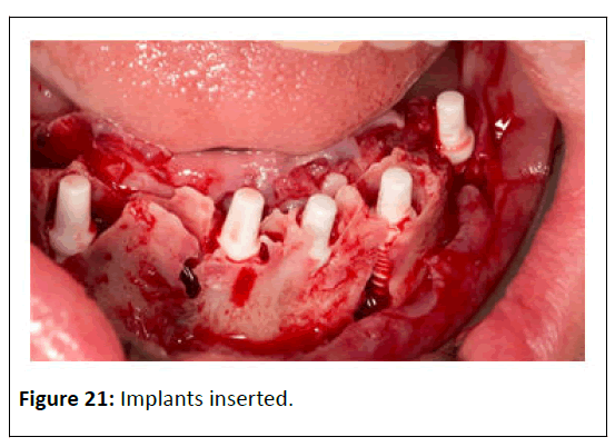 medical-case-Implants