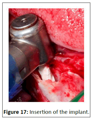 medical-case-Insertion