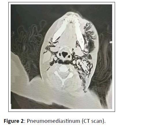 medical-case-Pneumomediastinum