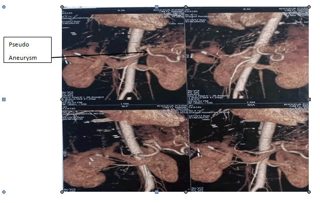 medical-case-aneurysm