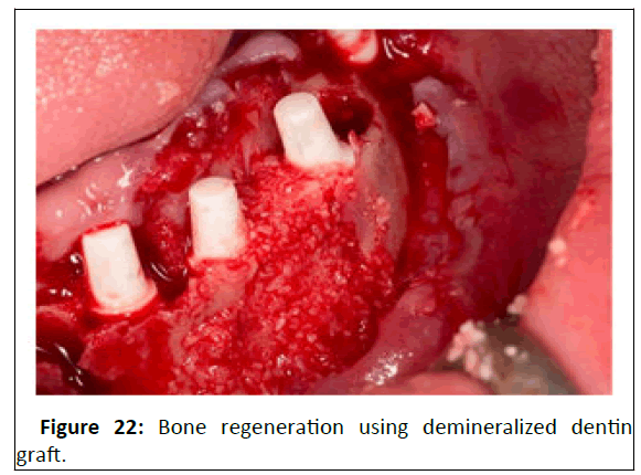 medical-case-demineralized