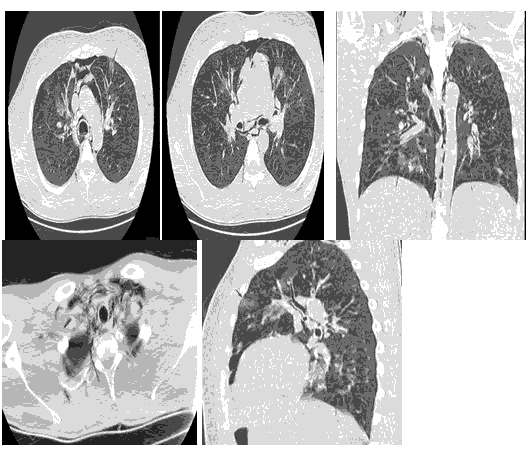 medical-case-pnuemomedadiastinum