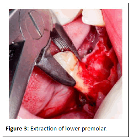 medical-case-premolar