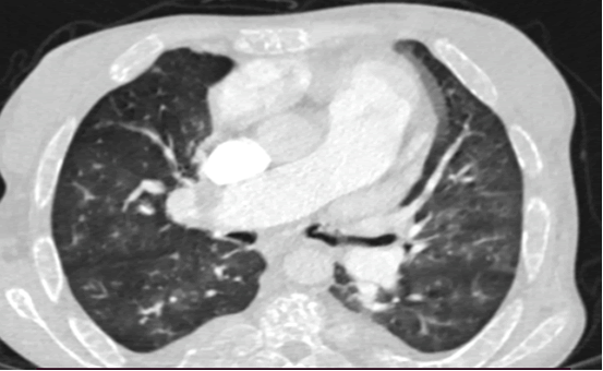 medical-case-pulmonary