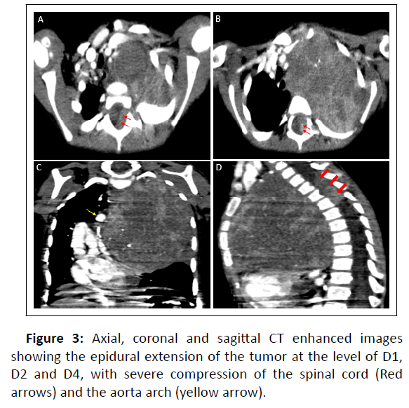 medical-epidural