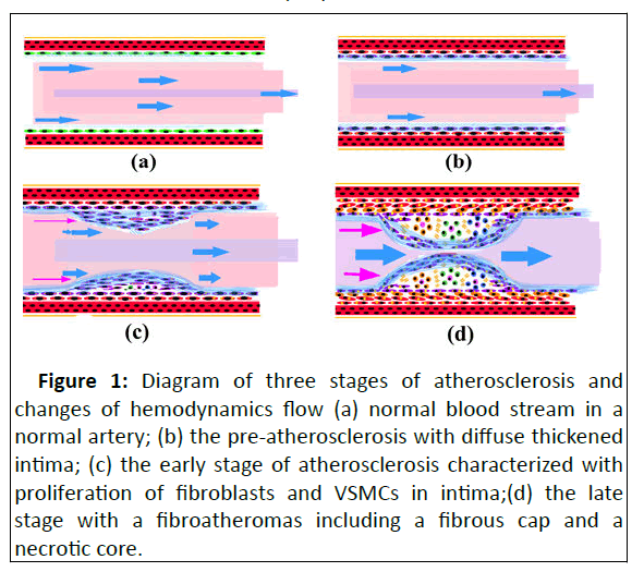 nursing-atherosclerosis