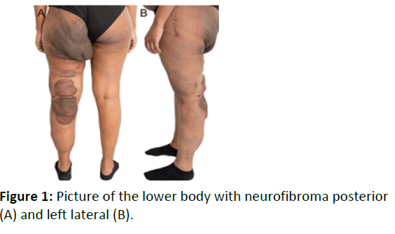 rare-disorders-neurofibroma