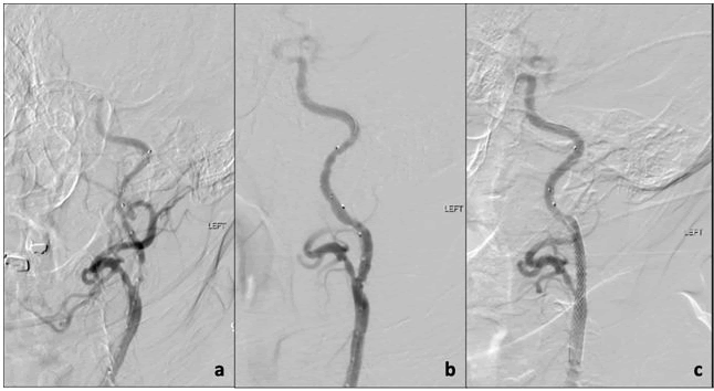 vascular-endovascular-aniography