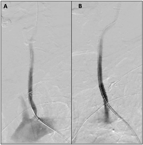 vascular-endovascular-carotid