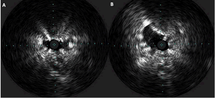 vascular-endovascular-case