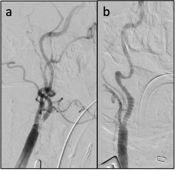 vascular-endovascular-post-angio