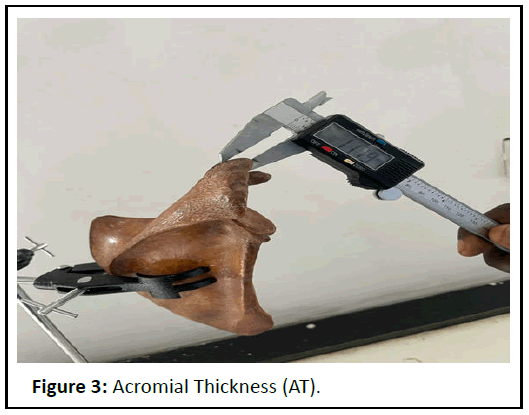 IPJASR-Acromial