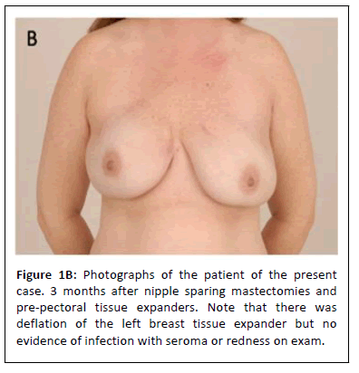 aestheti-mastectomies