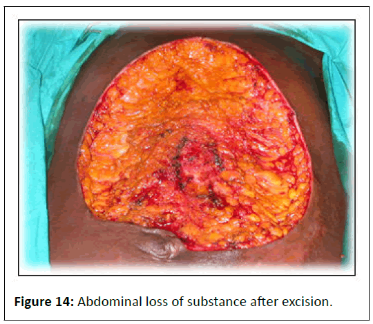 aesthetic-reconstructive-abdominal