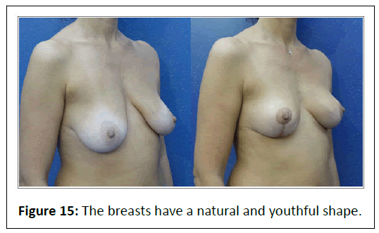 aesthetic-reconstructive-breasts
