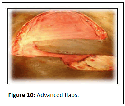 aesthetic-reconstructive-flap