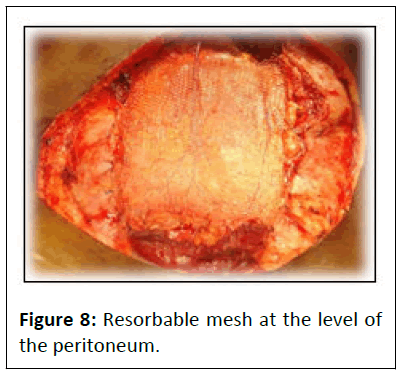 aesthetic-reconstructive-peritoneum