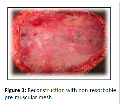 aesthetic-reconstructive-pre-muscularl