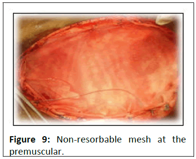 aesthetic-reconstructive-premuscular