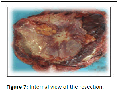 aesthetic-reconstructive-resection