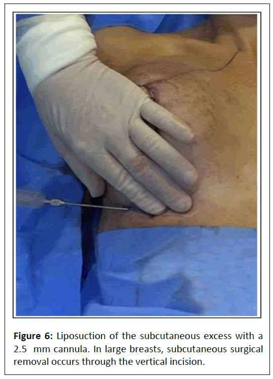 aesthetic-reconstructive-subcutaneous