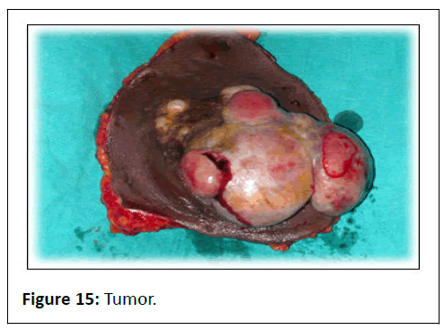 aesthetic-reconstructive-tumor
