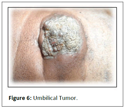 aesthetic-reconstructive-umbilical